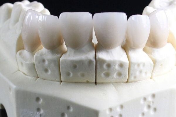 About Porcelain Laminate Teeth