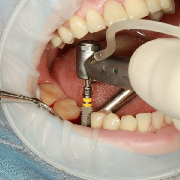 Are-dental-implants-a-good-solution-for-me