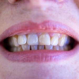 White Spots on Teeth