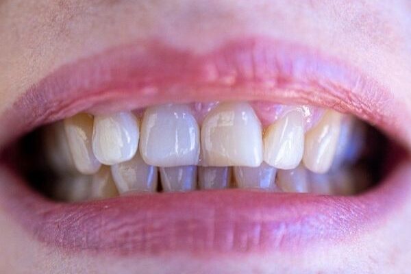 White Spots on Teeth