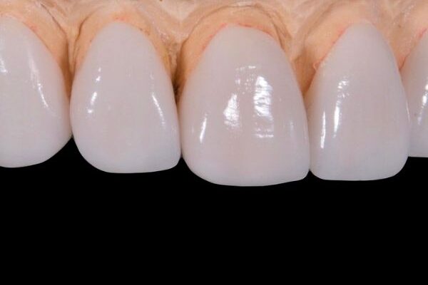 dental veneers