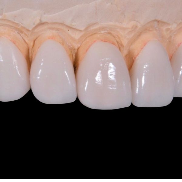 How dental veneers can protect your teeth?